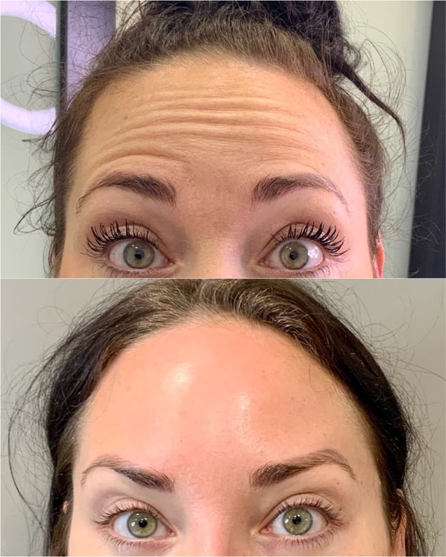 Forehead Botox treatment results – smooth expression lines by Dr. Fuzayloff, Manhattan
