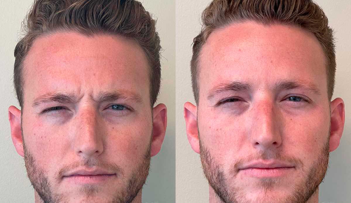 Frown line Botox results – softened “11” lines, NYC aesthetic treatment