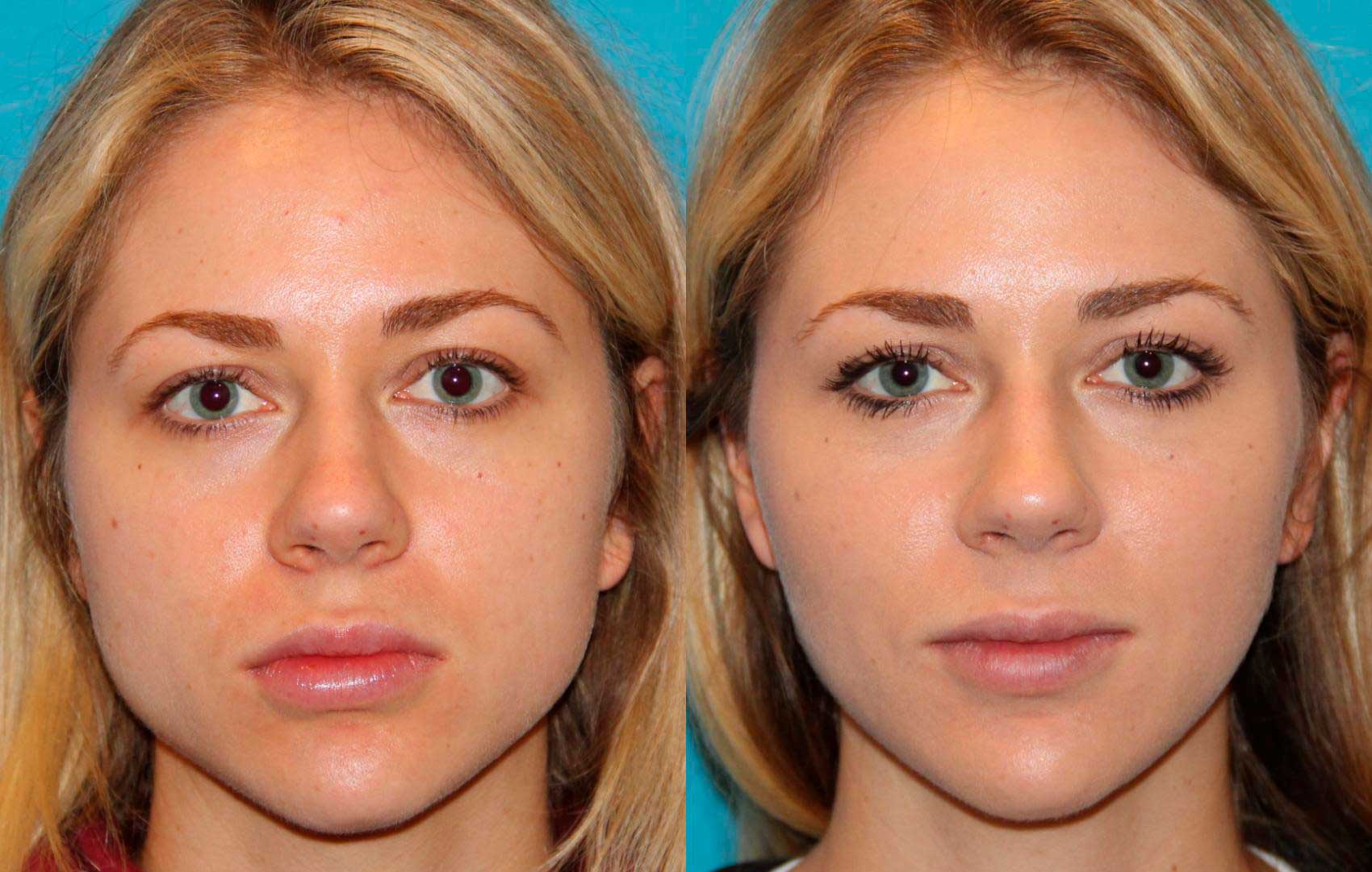 Before and after Botox for jaw slimming (masseter reduction) – Midtown Med Spa NYC