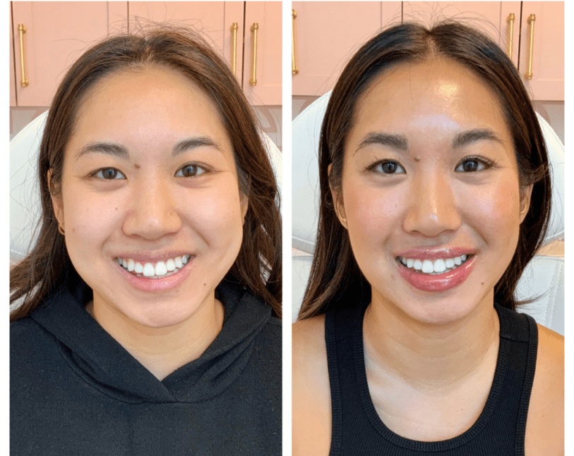 Botox masseter contouring – softer jawline, Dr. Fuzayloff, NYC