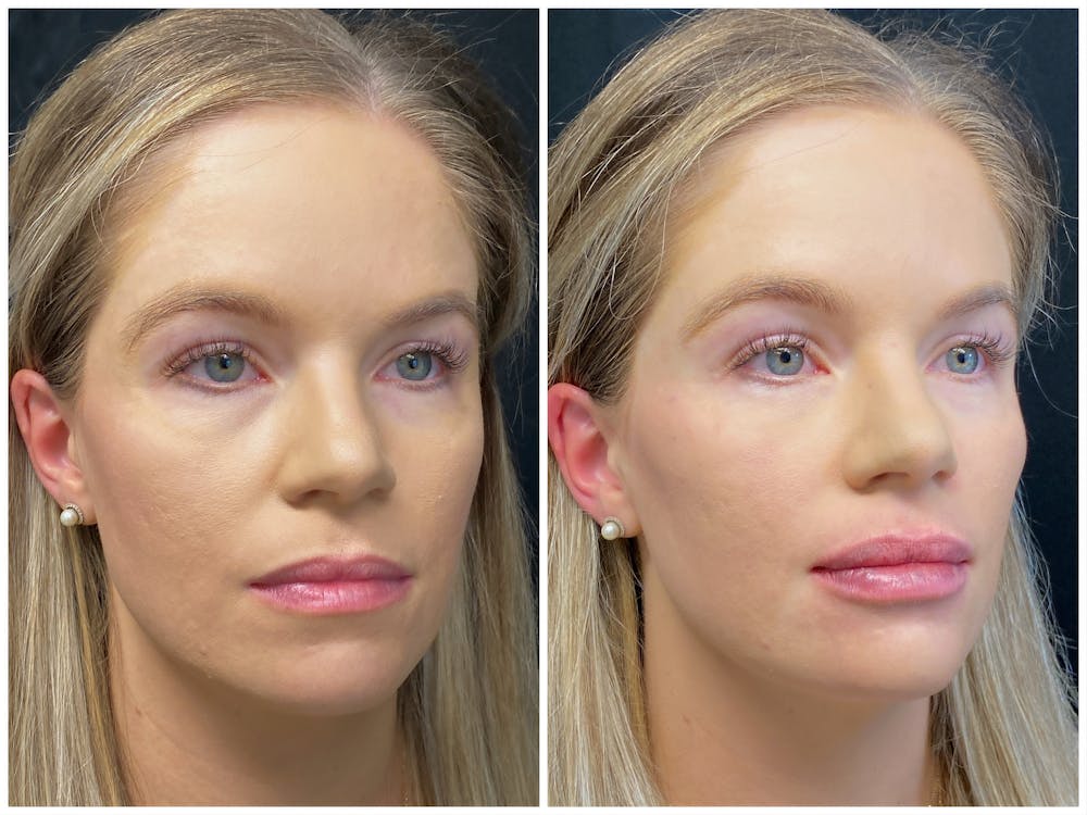Malar filler for midface lift – natural cheek definition, Manhattan