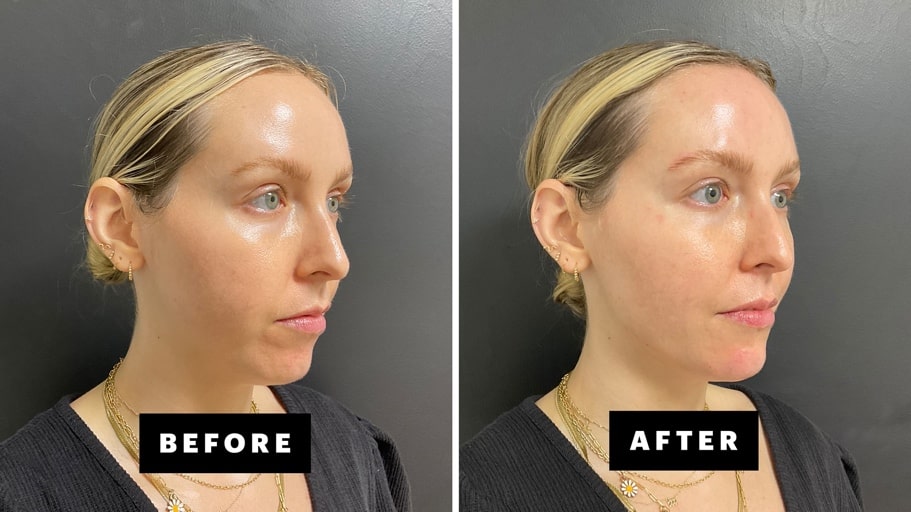 Chin filler results – improved profile balance by Dr. Fuzayloff, NYC