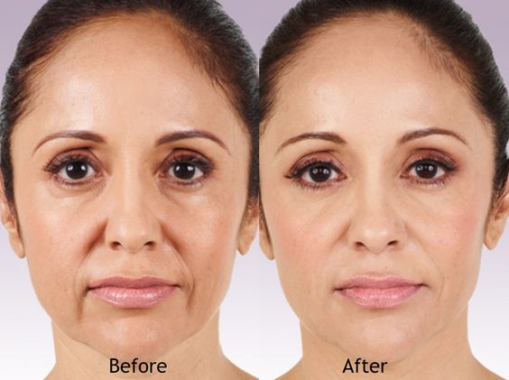 Before and after filler for marionette lines – Midtown Med Spa NYC