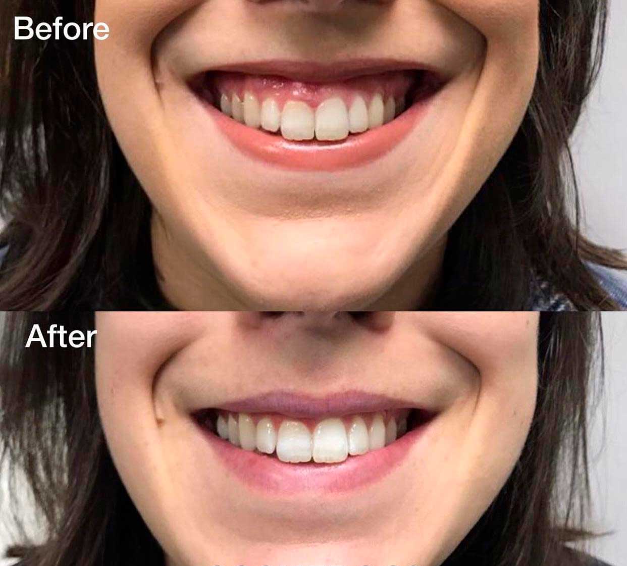 Gummy smile treatment with Botox – Dr. Fuzayloff, Manhattan med spa
